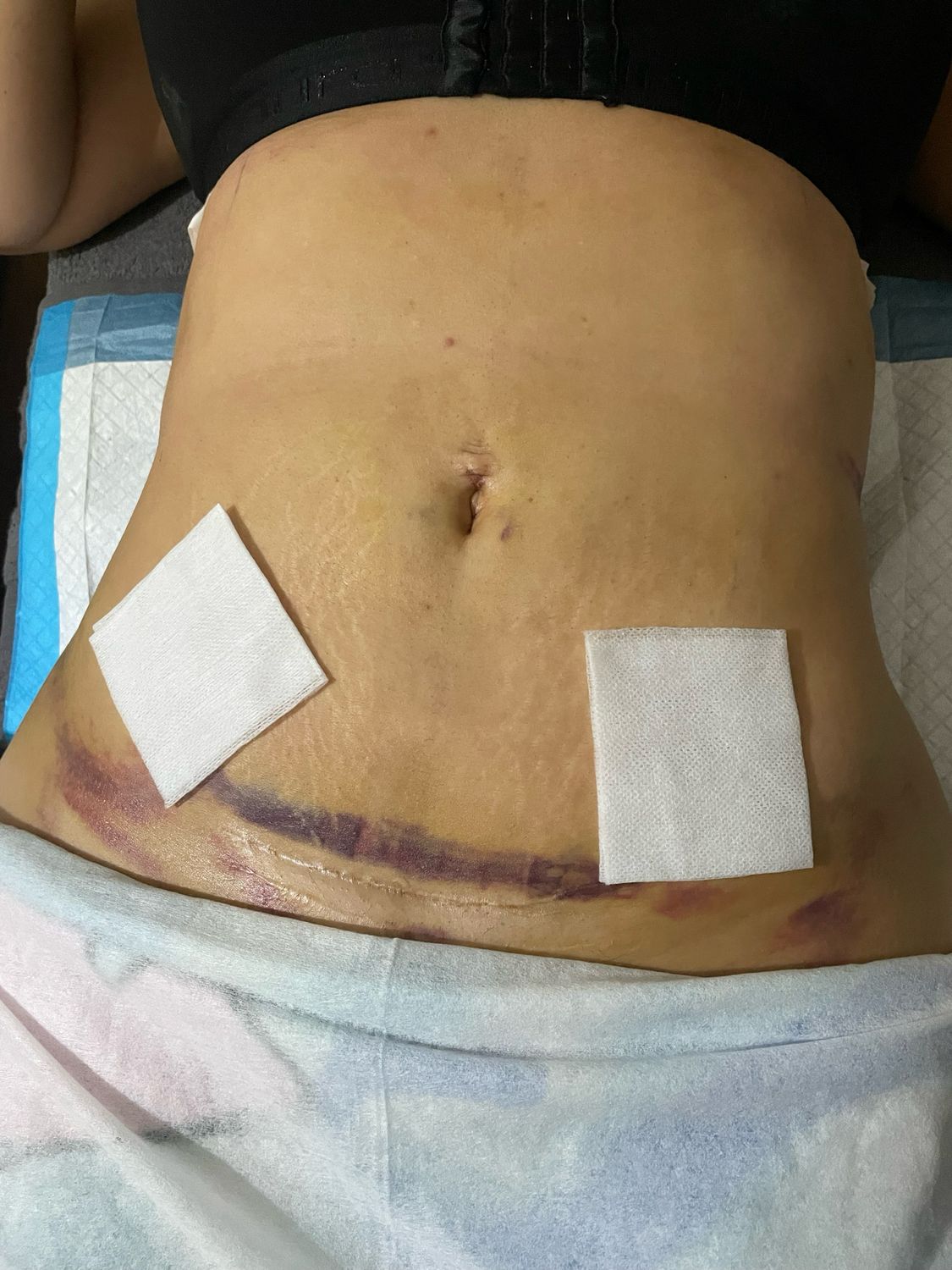 Postoperative lymphatic drainage