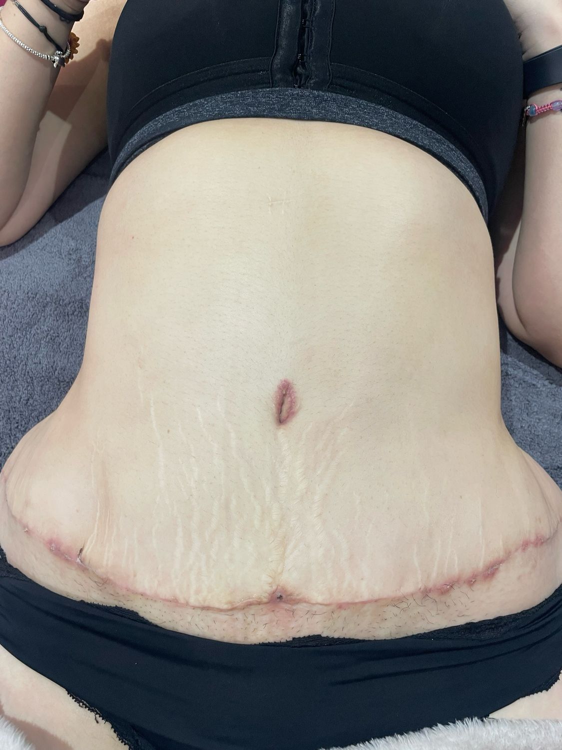 Postoperative lymphatic drainage