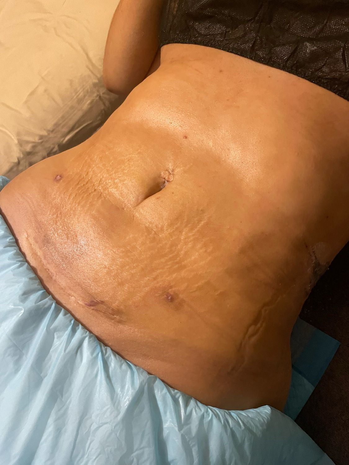Postoperative lymphatic drainage