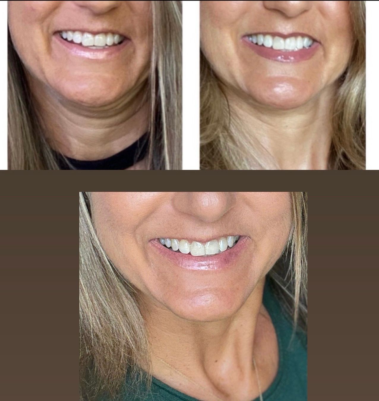 Neck Cream Bundle