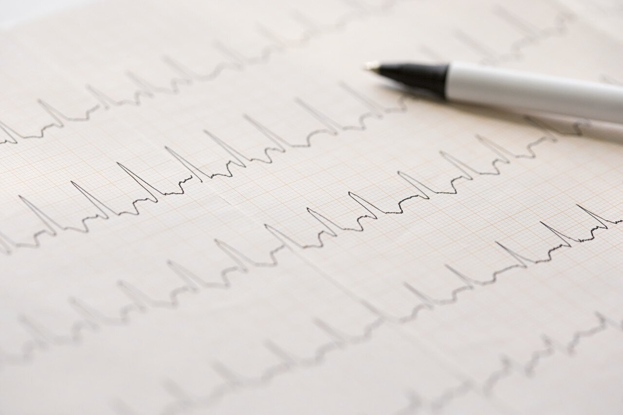 EKG