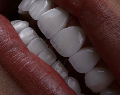 Carillas Dentales