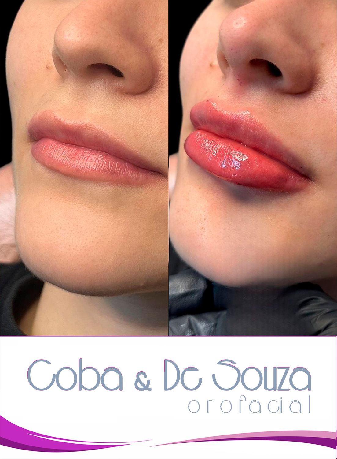 Contorno y Volumen Labial