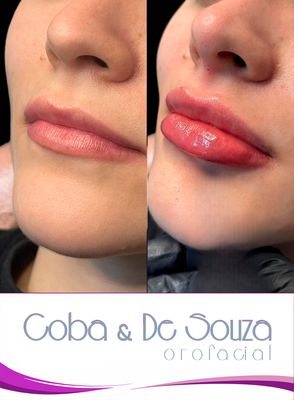 Contorno y Volumen Labial