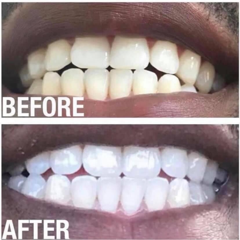 Whitening Toothpaste