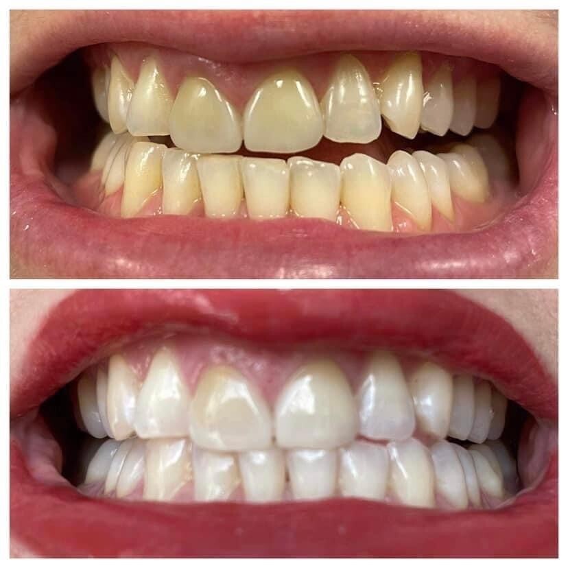 Whitening Toothpaste