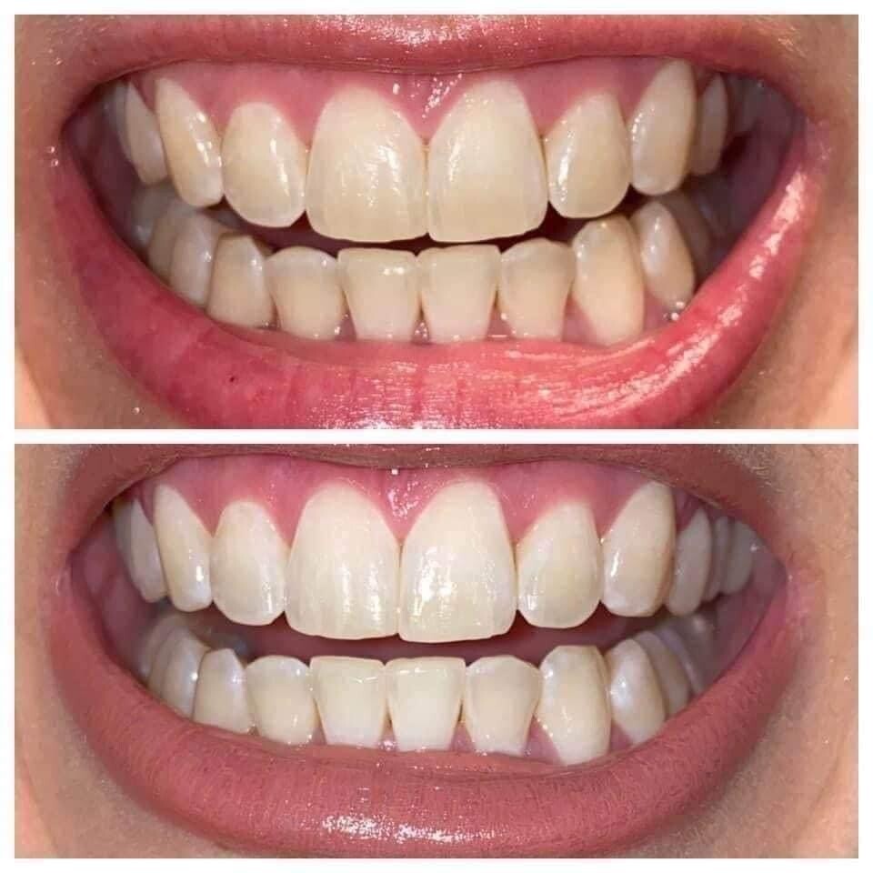 Whitening Toothpaste