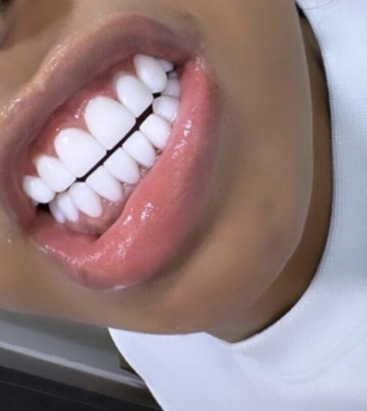 10 TOP 10 BOTTOM FULL SET OF COMPOSITE VENEERS