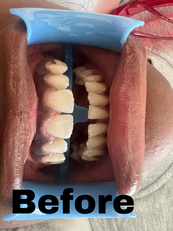 FULL SET OF 16- 8 TOP 8 BOTTOM COMPOSITE VENEERS