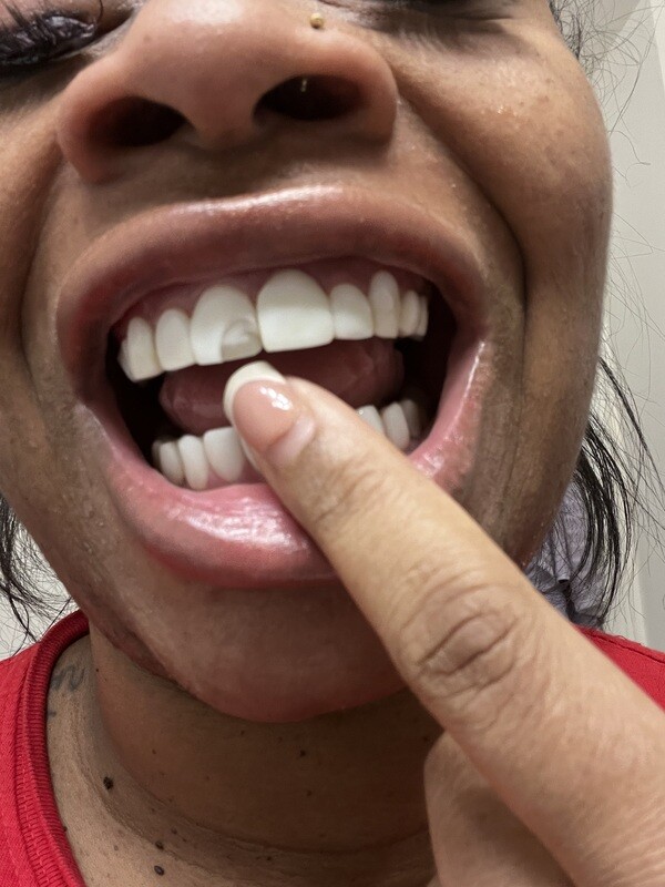 Composite Veneer Repair (WITHOUT Sparkling Halo Veneers in-house insurance)