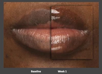 Peptide Lip Pout