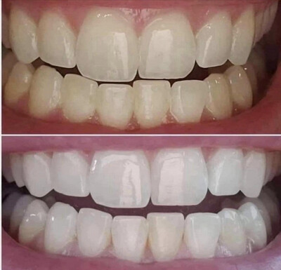 Whitening Toothpaste