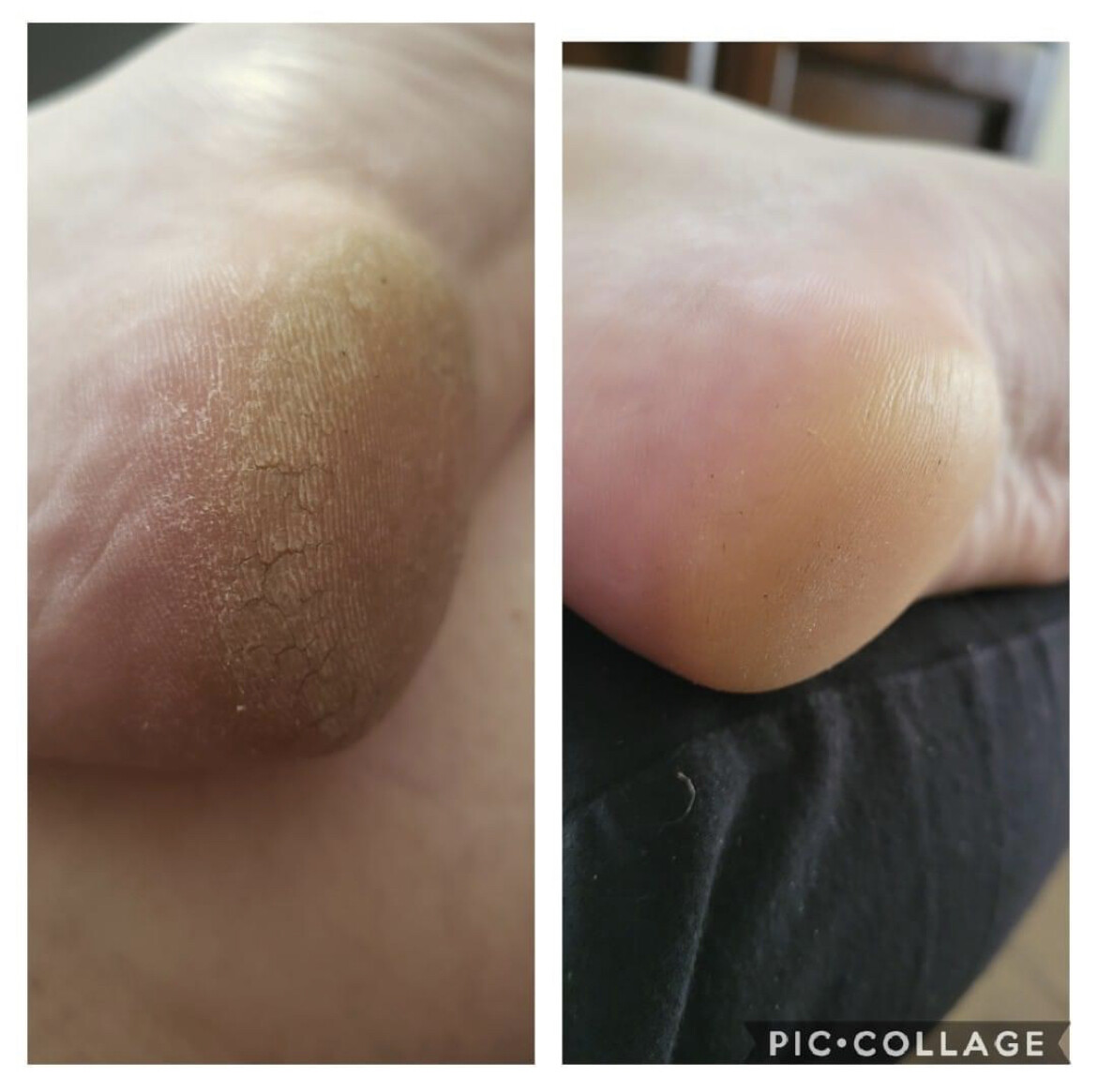 Pedicure Cream