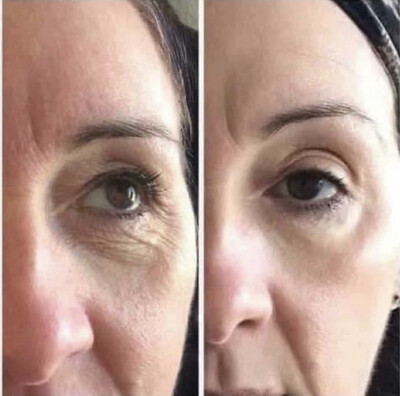 Botox Beads