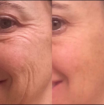 Uplifting Cream &amp; Botox Bead Bundle