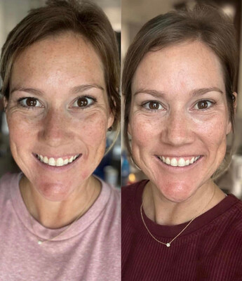 Vitamin C &amp; Collagen Pump