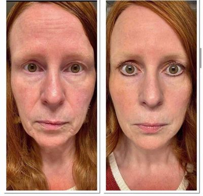 Retinol