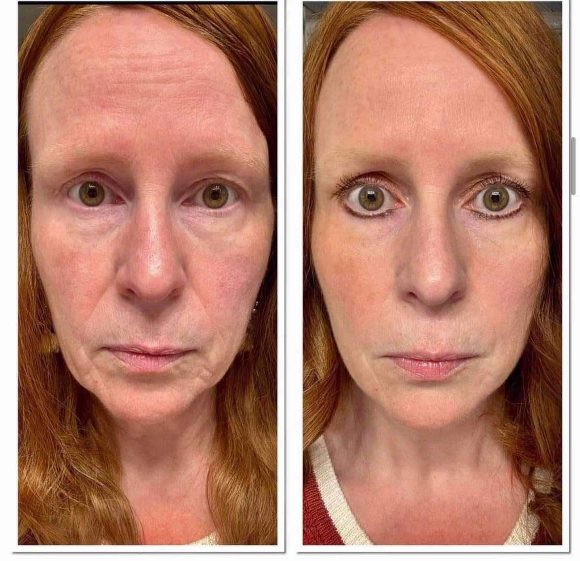 Retinol