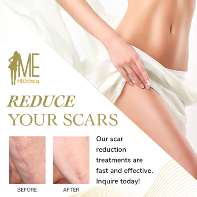 Fractional Scaring &amp; Resurfacing
