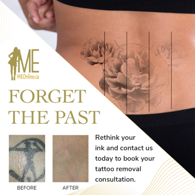 Tattoo Removal