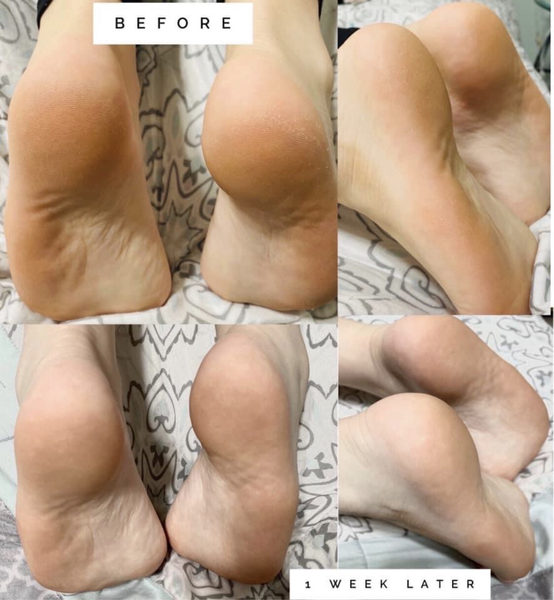 Sole Solution Foot Treatment