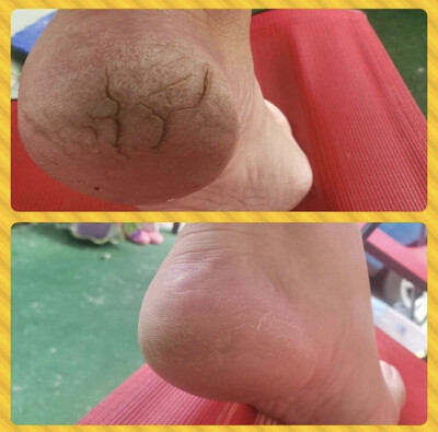 Sole Solution Foot Treatment