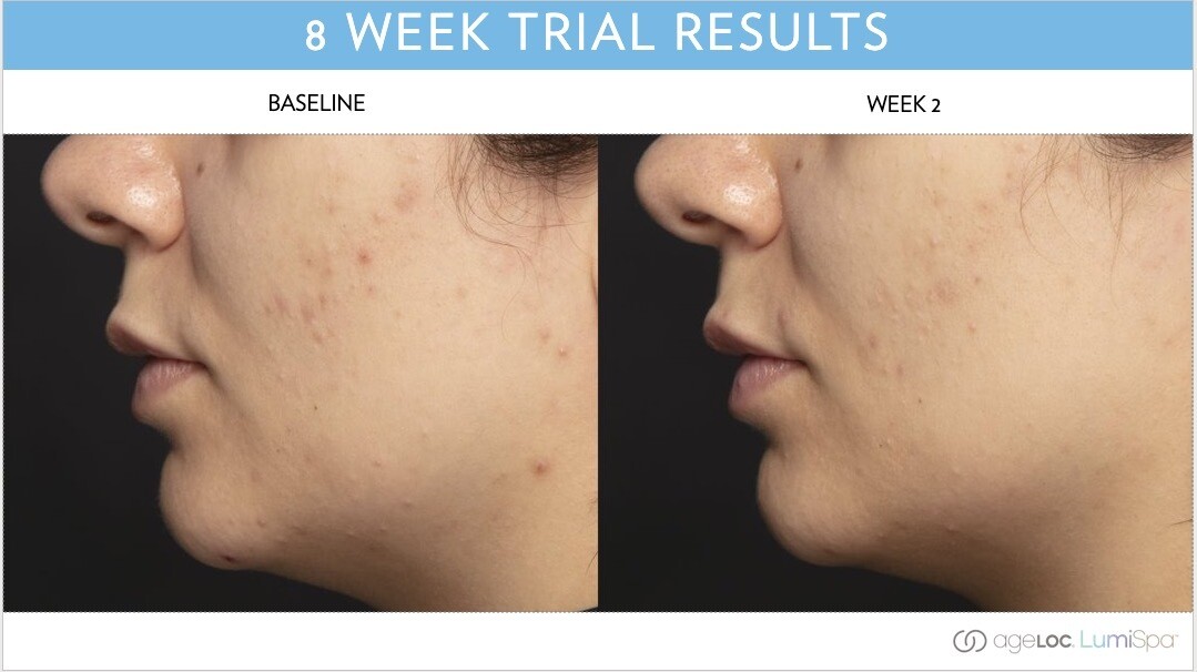 Blemish serum