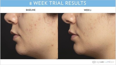 Blemish serum