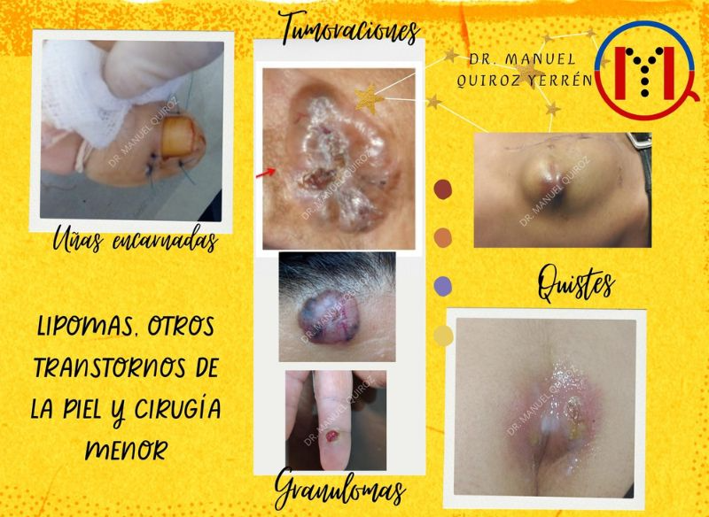 Cirugías Menores