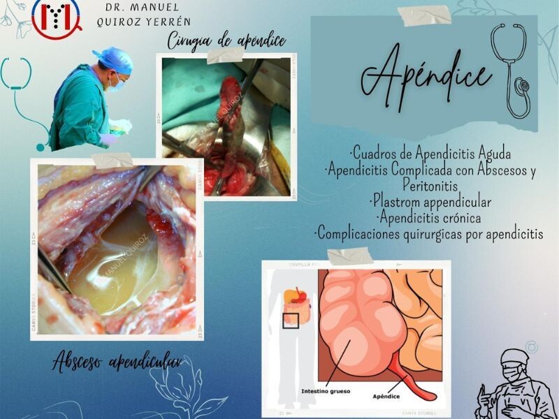 Cirugía de Apendicitis