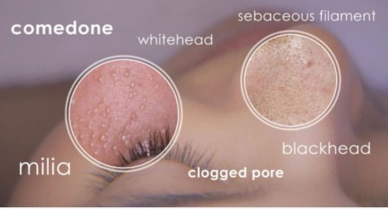 Comedone Extractions Treatment with Plasma Phi-Ion