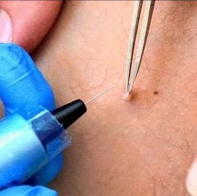 Skin Tags Removal with Plasma Phi-Ion