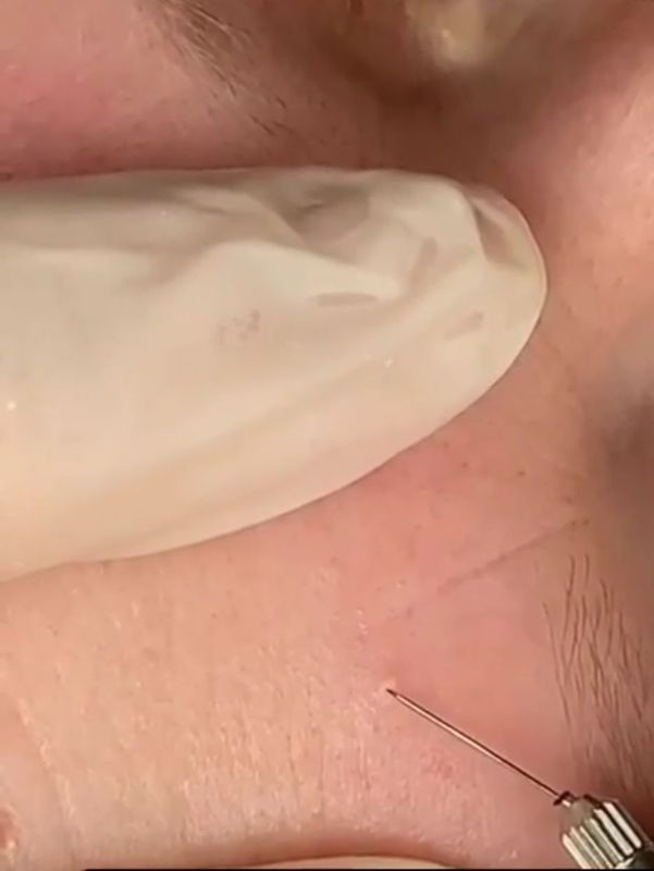 Milia Removal with Plasma Phi-Ion