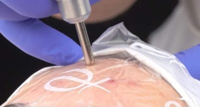 Acne Treatment with Plasma Phi-Ion