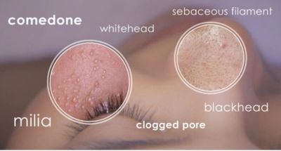 Comedone Extractions Treatment with Plasma Phi-Ion