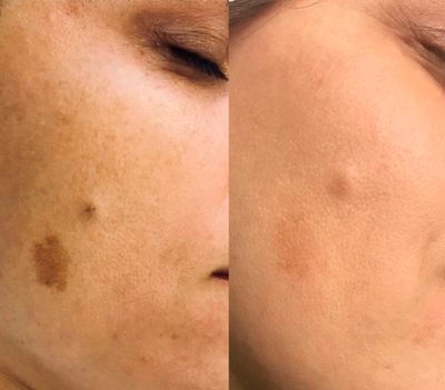 Pigmentation/Sun Spot/Age Spot Removal with Plasma Phi-Ion