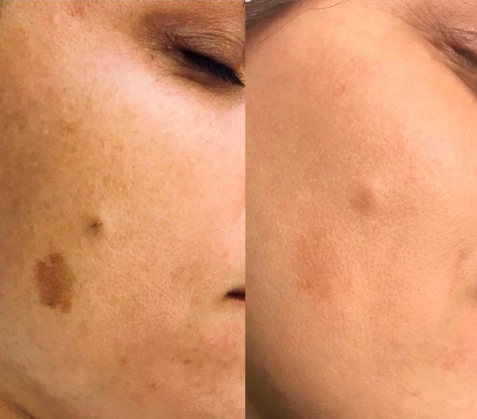 Pigmentation/Sun Spot/Age Spot Removal with Plasma Phi-Ion