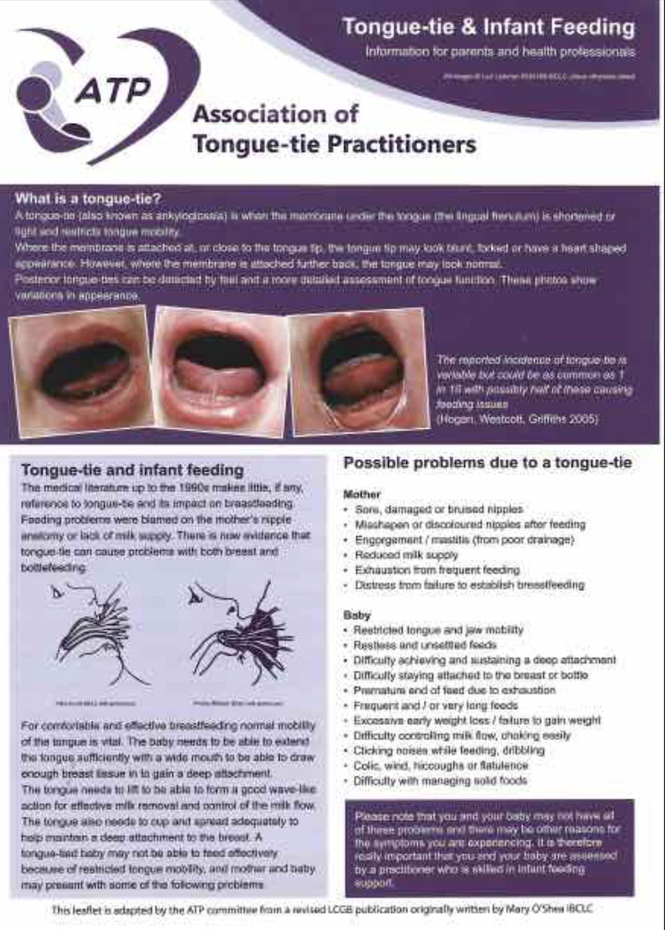 Tongue Tie & Infant Feeding leaflet (For voluntary Infant Feeding support groups)