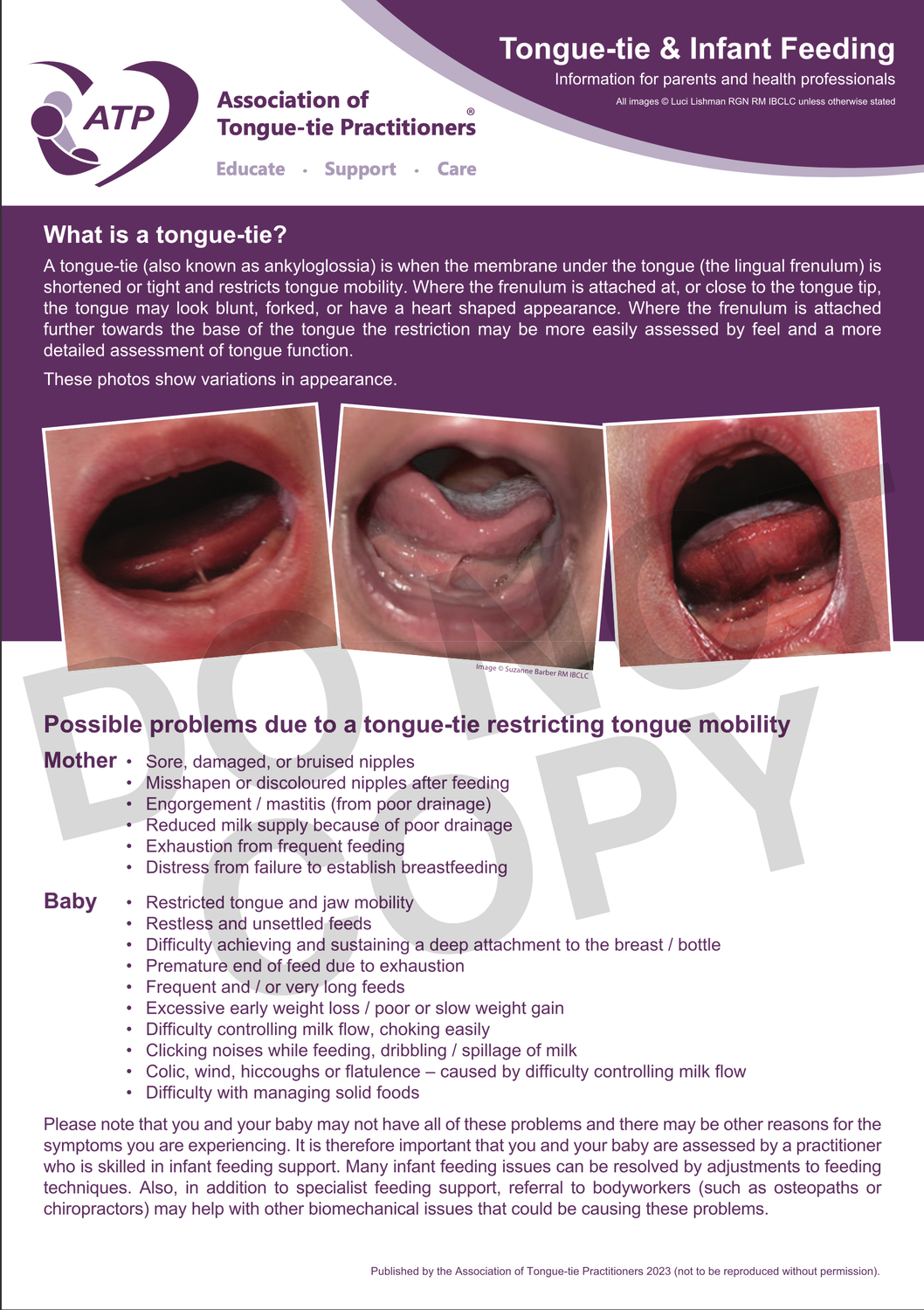 Tongue-tie & Infant Feeding (2023) *FREE DOWNLOAD*