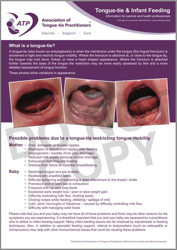 Tongue-tie & Infant Feeding (2023) *FREE DOWNLOAD*