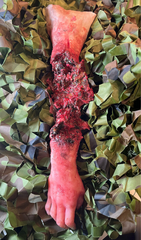 Teilamputation Unterarm