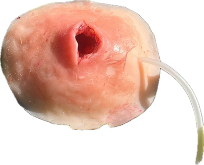 Schusswunde mit Wundhöhle