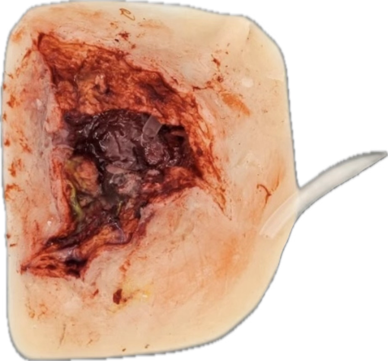 Explosionswunde mit Wundhöhle