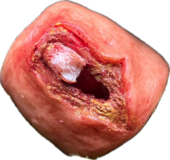 Wound Packing Trainer mit Knochen