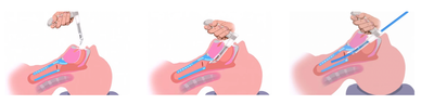 VieScope® – Laryngoscoop voor éénmalig gebruik98