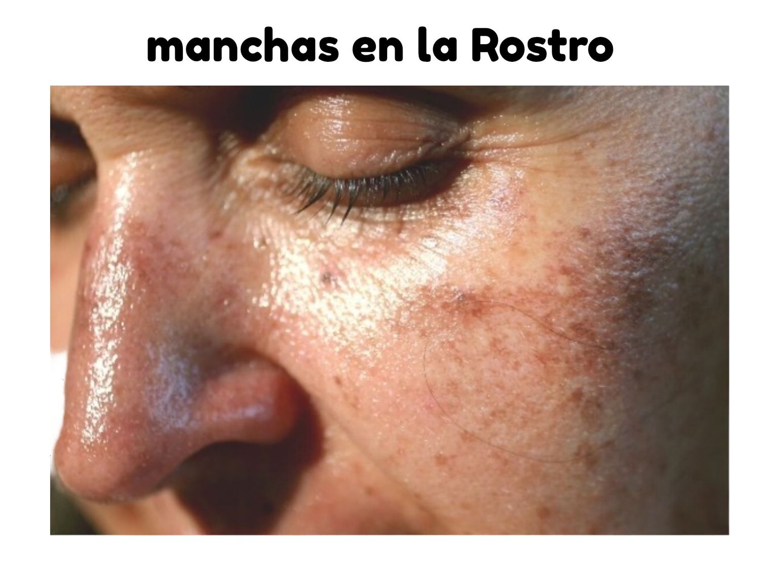 Manchas en el Rostro Hombre y Mujeres