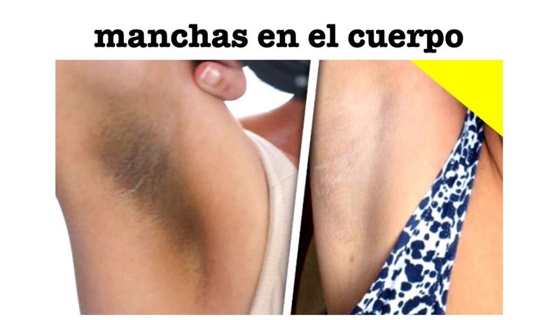 Manchas en el Cuerpo Hombre y Mujer