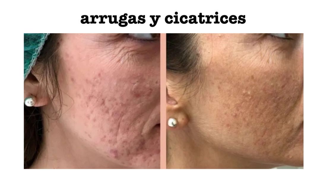 Arrugas y Cicatrices en la Cara Hombre y Mujer