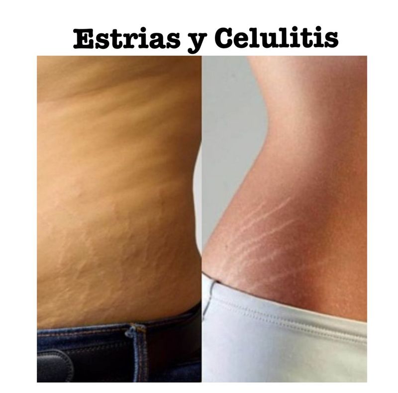Estrias y Celulitis Hombre y Mujer