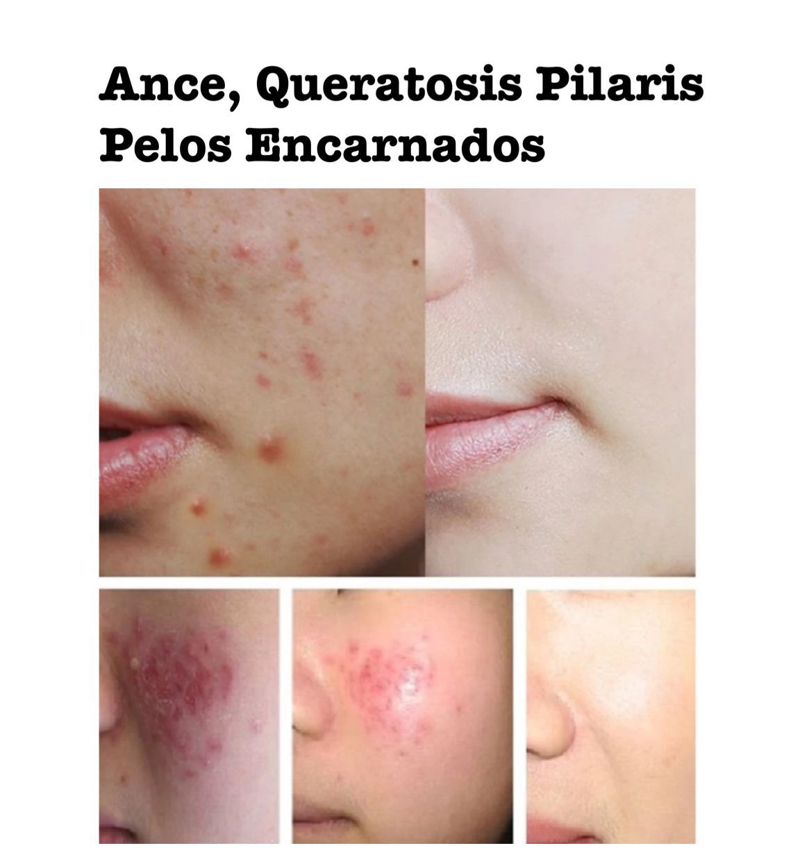 Acne, Queratosis Pilaris,.. en Hombre y Mujer